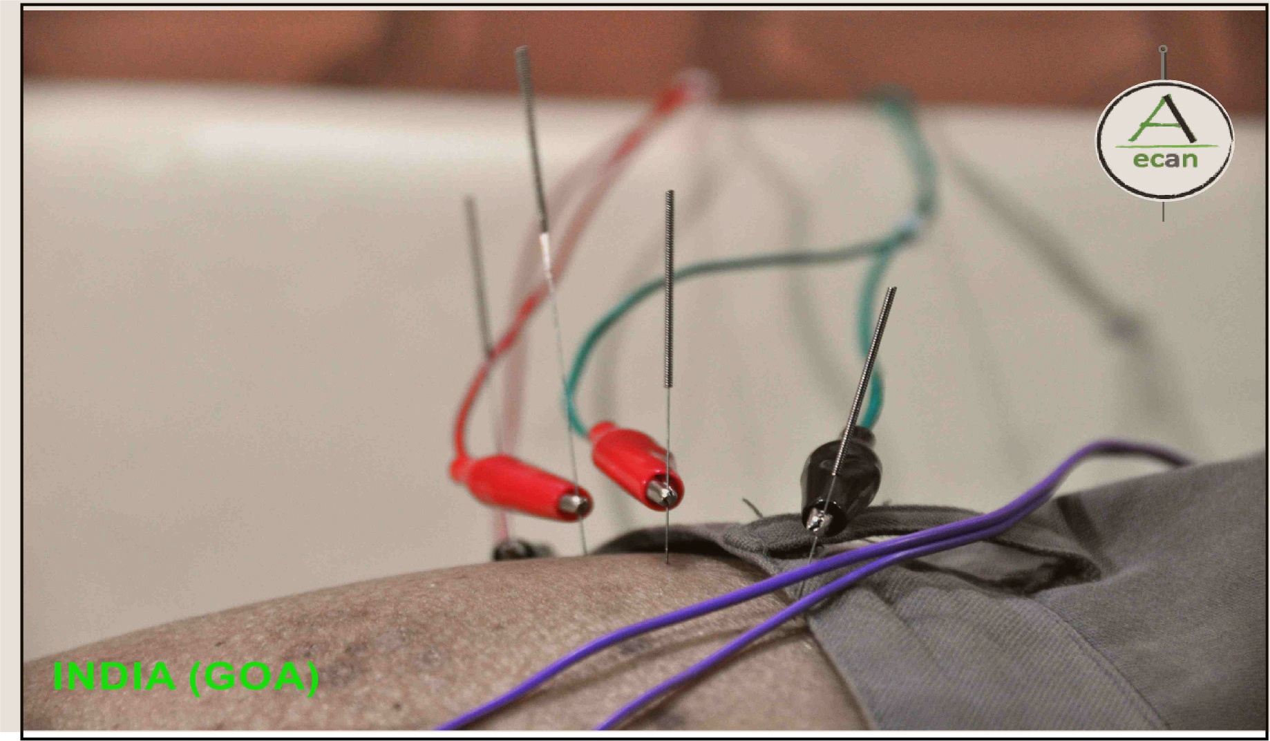 Electroacupuntura